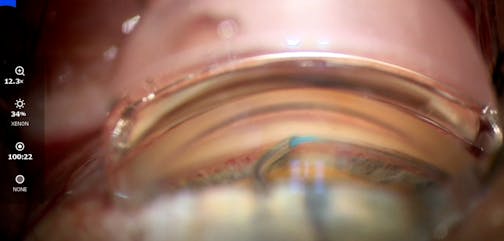 Standalone Viscodilation and Trabeculotomy