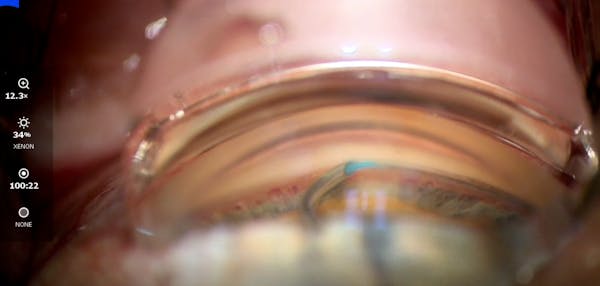 Standalone Viscodilation and Trabeculotomy thumbnail