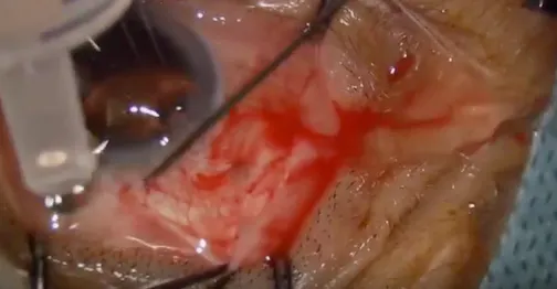 Triple Procedure for Traumatic Aphakia With Glaucoma and Mydriasis