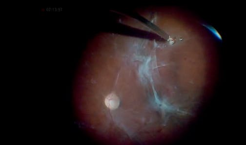 Fibrovascular Tissue and ILM Peel for Severe Diabetic Retinopathy With Retinal Detachment