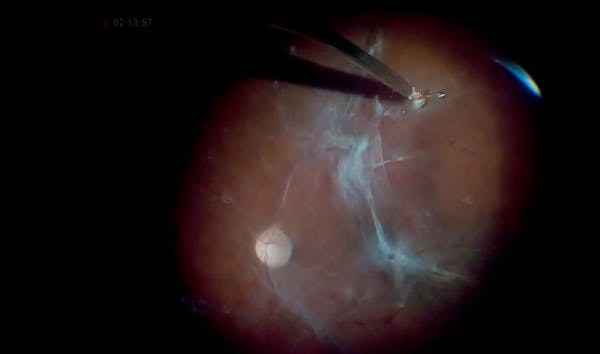 Fibrovascular Tissue and ILM Peel for Severe Diabetic Retinopathy With Retinal Detachment thumbnail