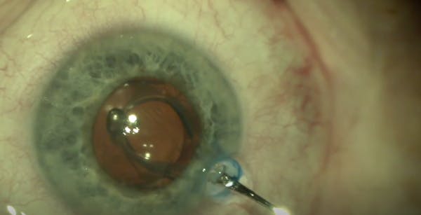 Avoiding Pupillary Dilation Disasters thumbnail