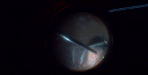 Iatrogenic Tear During Retinal Detachment Repair