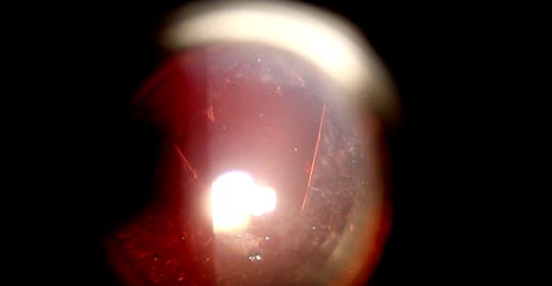 Evolution of YAG Capsulotomy