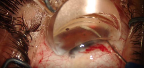 iTrack Advance and Hydrus Microstent