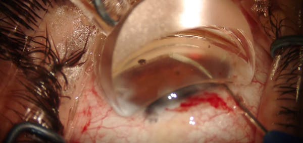 iTrack Advance and Hydrus Microstent thumbnail