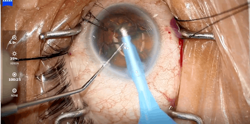 miCOR Teaching Video