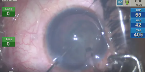 Phacoemulsification in Soft Cataracts