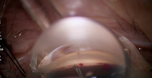 Combination MIGS: iTrack Advance With iStent Infinite