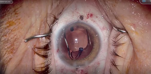 IPure IOL Implantation