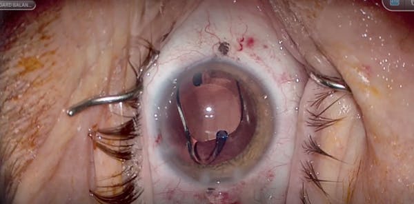 IPure IOL Implantation thumbnail