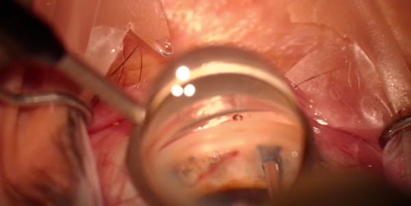 iStent Inject W and Streamline Surgical System thumbnail
