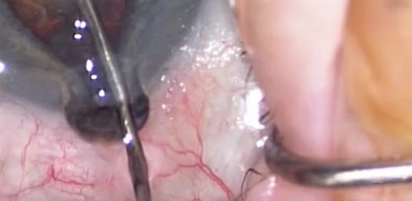 Recognizing Early Iris Prolapse thumbnail