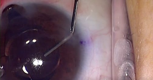 Management of Iris Prolapse - Eyetube