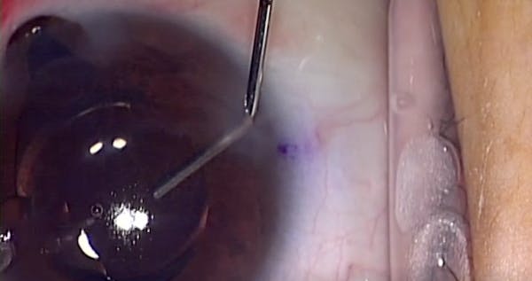 Management of Iris Prolapse thumbnail