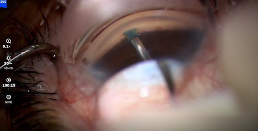 Canal Blanching With Streamline