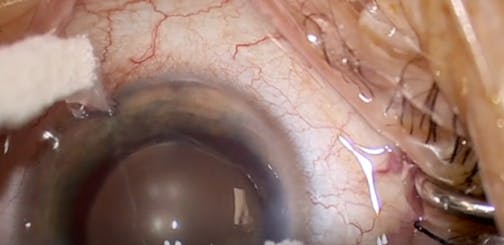 Blanching in a Combination Streamline and Hydrus Case