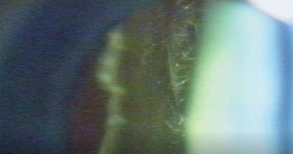 Posterior Vitreous Cortex Folds After Posterior Vitreous Detachment thumbnail