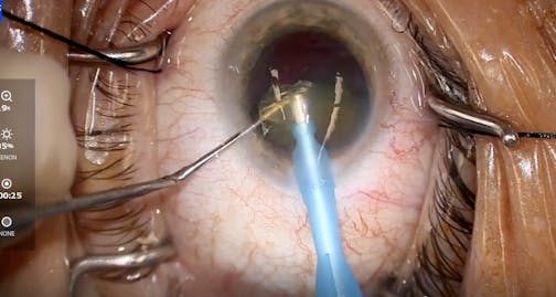 miCOR for Dense Cataract