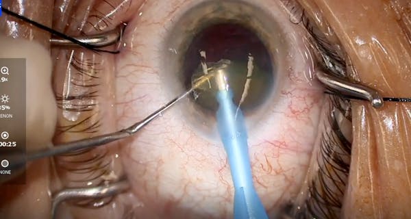 miCOR for Dense Cataract thumbnail