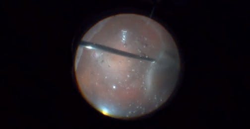 Combined Procedure for a Myopic Retinal Detachment