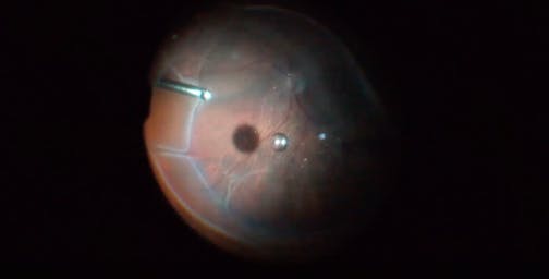 Shallow Retinal Detachment With Subretinal PVR