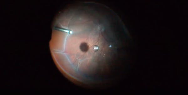 Shallow Retinal Detachment With Subretinal PVR thumbnail
