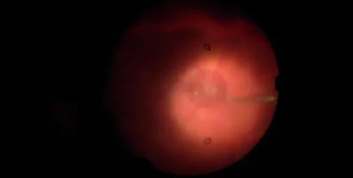 Repairing a Hidden Scleral Rupture