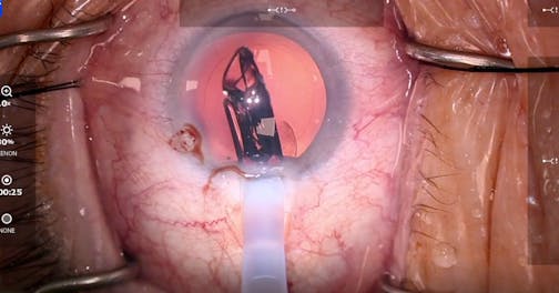 Apthera IC-8 IOL Implantation
