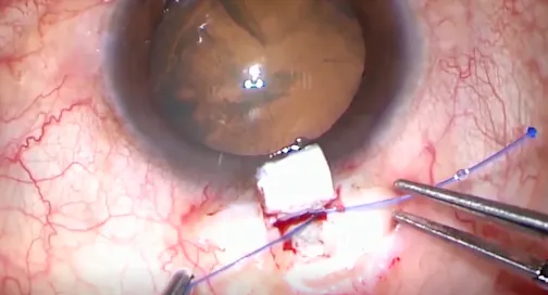 Combined Circumferential Suture Trabeculotomy and Phacoemulsification