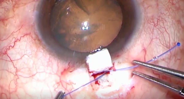 Combined Circumferential Suture Trabeculotomy and Phacoemulsification thumbnail