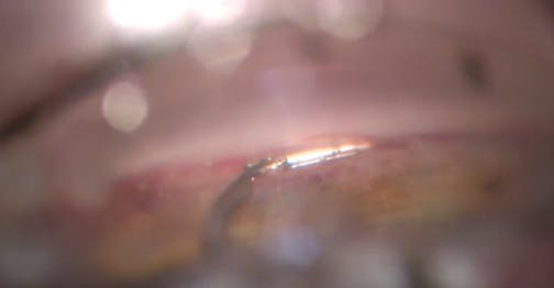 Backhand Technique for Hydrus Implantation