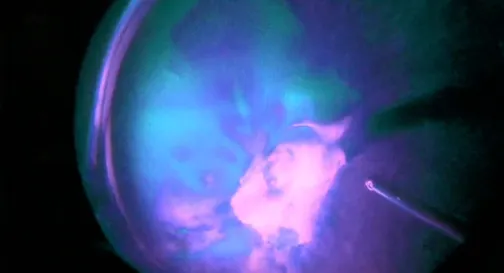 PDR With Advanced Digital Filtering and Intraoperative Navigation