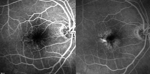 Real-World Treatment-Naïve Case: Bilateral Wet AMD in a 92-Year-Old Patient