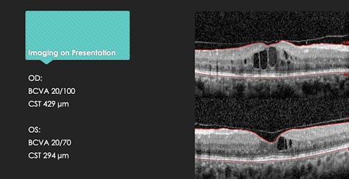 Real-World Step Therapy Case: A Challenging DME Patient