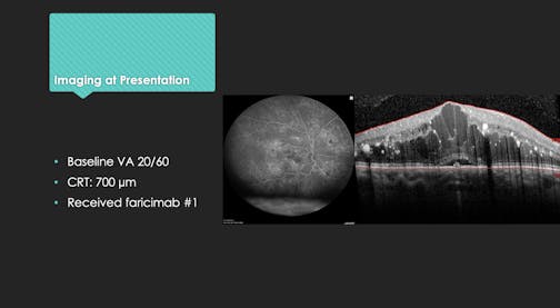 Real-World Treatment-Naïve Case: Treating DME With a Dual-Inhibition Approach