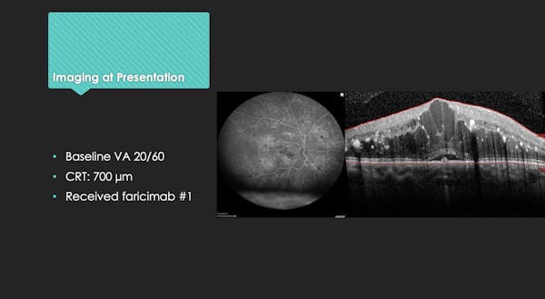Real-World Treatment-Naïve Case: Treating DME With a Dual-Inhibition Approach thumbnail