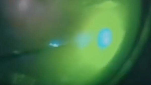360° Laser Retinopexy After PPV thumbnail