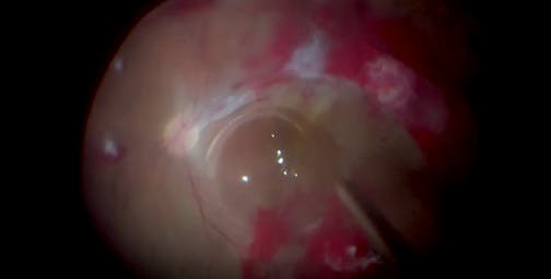 Fibrovascular Tissue Peel for Severe Diabetic Retinopathy With Retinal Detachment