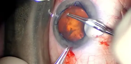 Phacoemulsification With Lysis of Synechiae and Malyugin Ring Implantation