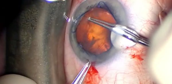 Phacoemulsification With Lysis of Synechiae and Malyugin Ring Implantation thumbnail