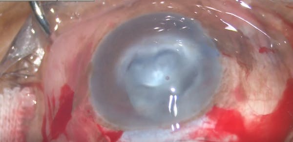 Mature Cataract With Corneal Scar thumbnail