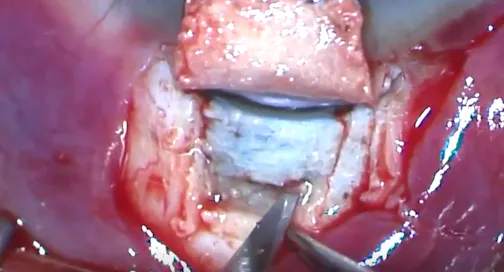 Nonpenetrating Deep Sclerectomy With Suprachoroidal Implant