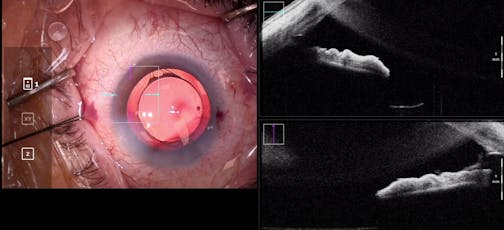 Hydrus Microstent Intraoperative OCT Verification