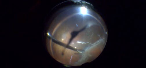 Failed Primary Retinal Detachment Repair