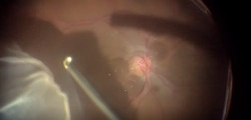 ILM Seal Technique for Large Macular Hole and Retinal Detachment