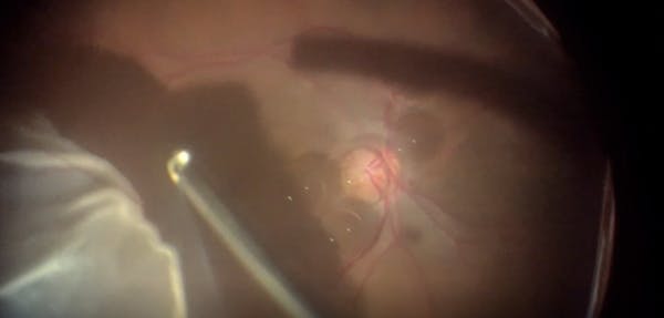 ILM Seal Technique for Large Macular Hole and Retinal Detachment thumbnail