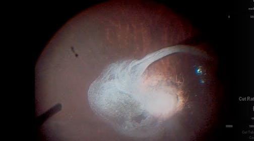 Inducing a Posterior Vitreous Detachment in a Pediatric Patient