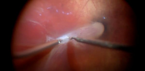 Vitrectomy in a Child With Incontinentia Pigmenti thumbnail