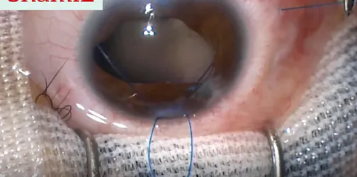 Scleral IOL Fixation Technique by Internal Loops
